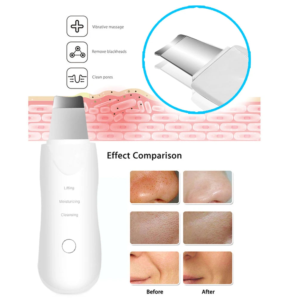 Spatule Faciale à Ultrasons — Nettoyant, Anti-Points Noirs & Masseur | MDN Store 25