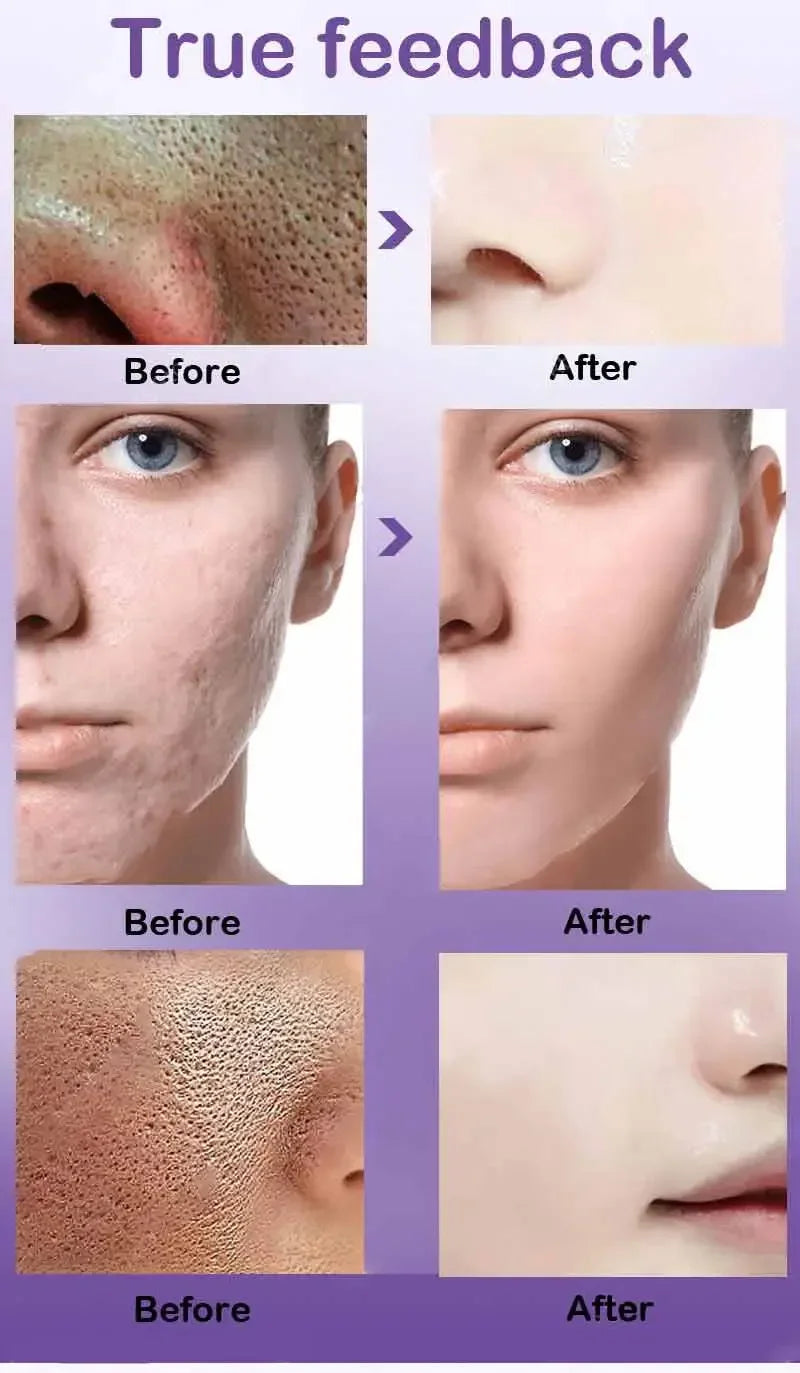Sérum Visage Rétinol Niacinamide Resurfaçant Pores Anti-Imperfections | MDN Store