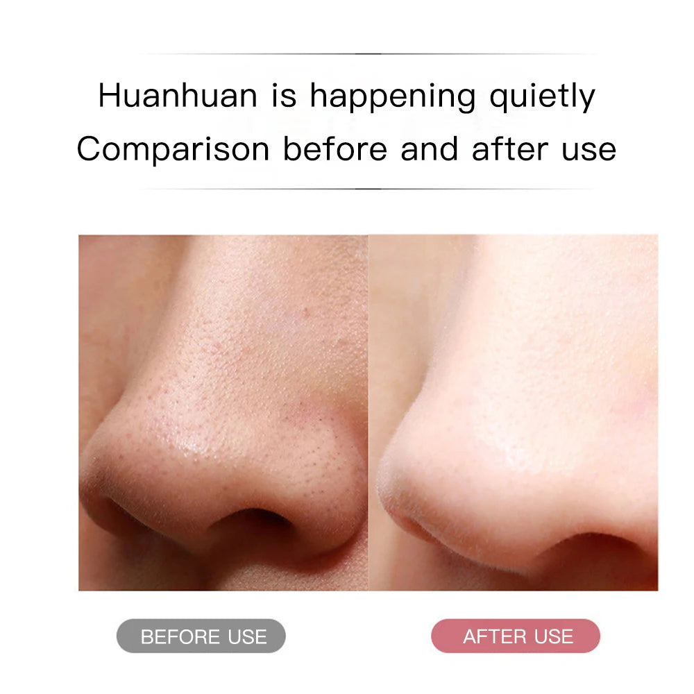 Epurateur de Peau Ultrasons Nettoyeur Pores Points Noirs EMS Visage | MDN Store 25